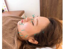 宇宿鍼灸整骨院/鍼灸【美容鍼】