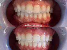 ココロビューティーギャラリー 武蔵小杉(cocorobeauty gallery)/ホワイトニング★お試し4照射