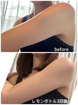 ラピスラズリ/【レモンボトル】二の腕3回