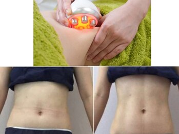 デイスパ ヴィータの写真/【３月限定】薄着の季節目前！ヤバいお腹のセル脂肪徹底撃退◎