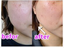 ボンド(BOND)/【脱毛サロン】光フェイシャル