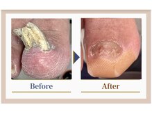 巻き爪補正店 錦糸町店/【変形爪再生補正】