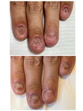 アネラ(Anela)/最強ネイルケア