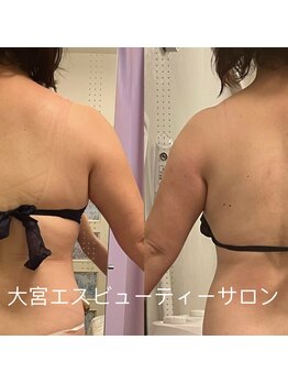 シンビューティーサロン 大宮本店/ブライダル背中二の腕脇肉ケア