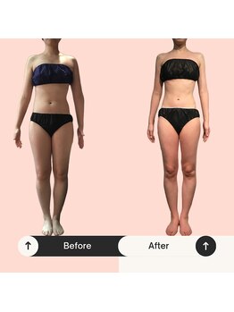 サンテボーテ(Sante Beaute)/筋膜と機器のWでサイズダウン