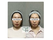 キュープ 静岡店(Qpu)/２０代、お悩み：頬骨、輪郭