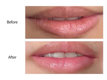 オーシャンブルー 大分店(OCEAN BLUE)/最新黒ずみケア《ローマピンク》