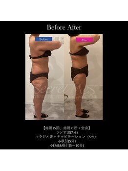 フェレザ 新潟(Felleza)/新潟-痩身エステ-BODYエステ