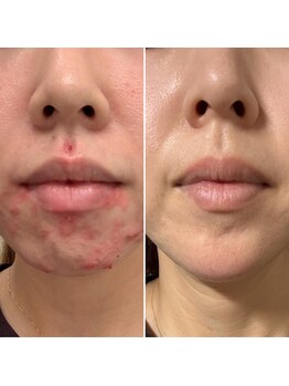 サロンドムーン(salon de MooN)/症例写真