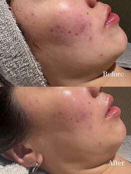 ウルソワン 都島店(/ulu soin)/ニキビ改善 1回