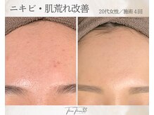 スリースリー 恵比寿(THREE THREE)/ニキビ・肌荒れケア