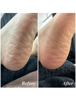 スパルーチェ角質ケア