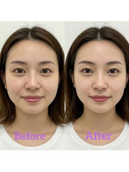 なごやの森/小顔・輪郭矯正ビフォーアフター