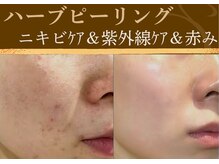 ムーンライズ(moonrise)の雰囲気（【紫外線ケア】毛穴からニキビ改善＆赤み改善同時に叶う◎↑）