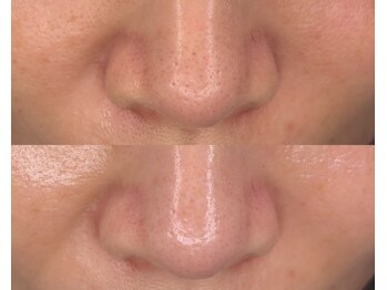 ル シーニュ/毛穴エクストラクション