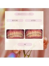 プラスビー 3号店(+b)/ホワイトニングビフォーアフター
