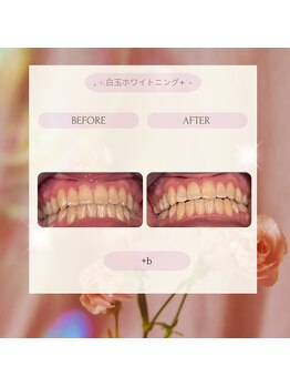プラスビー 3号店(+b)/ホワイトニングビフォーアフター