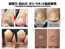 小山巻き爪センターの雰囲気（肥厚爪・割れ爪・タコ・魚の目施術事例[爪切りだけの施術もOK!]）