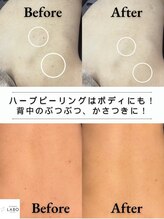 毛穴ラボ 梅田(毛穴LABO)&nbsp;背中 ニキビケア