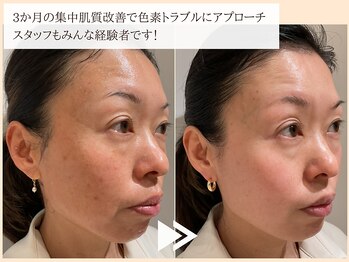 レイテノール 藤沢店の写真/【本気のシミ改善×エイジングケア】全国受賞歴多数◎高機能化粧品で内側から輝く透明美肌を実感♪