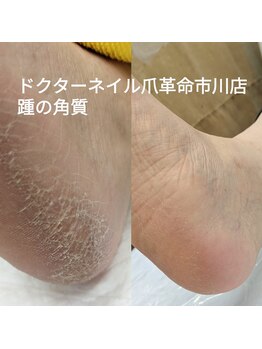 足裏の角質ケア