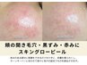 【毛穴開き/赤み悩みの方】皮脂,常在菌チェック付/スキングローピール¥9900