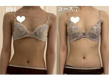 ギフト 浦和(GIFT)/バストアップ症例