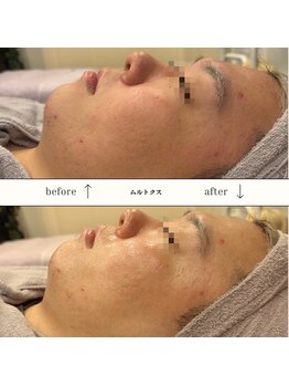 ビーエヌ エステティックアンドスパ(BN Esthetic&Spa)/男性もムルトクスですっきり♪