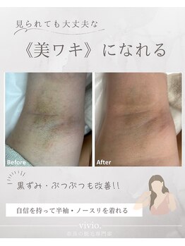 ヴィヴィオドット(vivio.)/脇脱毛／奈良県大和高田市