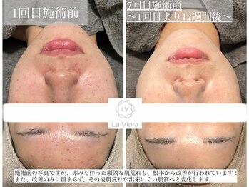 ラヴィオーラ 神戸三宮店(La Viora)/ダイヤモンドハーブピーリング