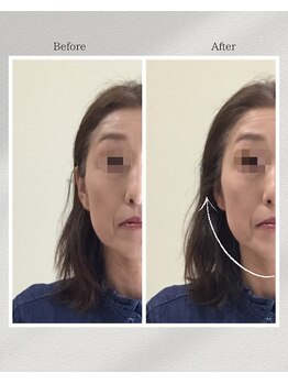 トータルトリートメント優鍼灸院/美容鍼　１回の効果