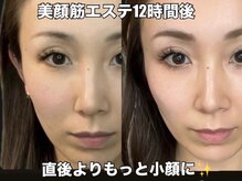 リエル(RIEL)/【美顔筋育成】