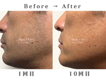 モンシェリ 広島店(Mon Cheri)/ヒゲ脱毛Before→After