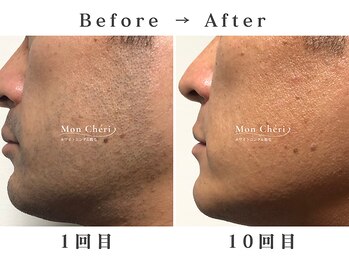 モンシェリ 広島店(Mon Cheri)/ヒゲ脱毛Before→After