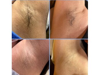 スキンラボ カホクカイ(KaHokuKai)/１回/4周　　３回目