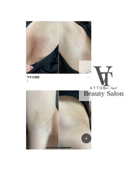 アット(ATTO)/ワキ脱毛