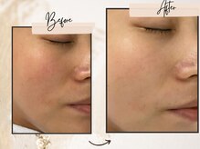 コンビンス(convince)/名古屋中区肌質改善美肌実績あり