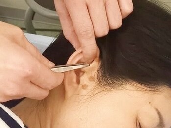 辻鍼灸接骨院の写真/今話題の耳つぼがお手軽な金額で体験ができる◎耳つぼを刺激してお顔や身体のお悩みを改善！
