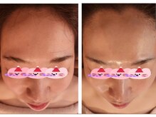 シェノン(Chainon)/セラピールで圧倒的なツヤ肌へ！