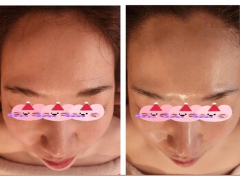 シェノン(Chainon)/【セラピール1回】ツヤ透明感UP