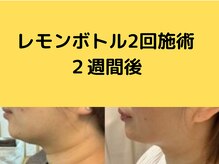 フェリス(feliz)/レモンボトル[小顔/美白/白石区]