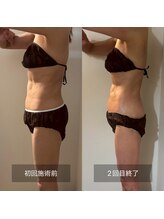 フィエルテ 甲斐敷島(FIERTE)/ハイパーナイフ beforeafter