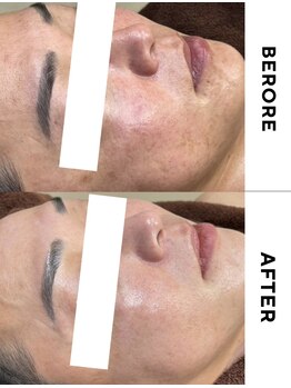 ゼロ(ZERO)/ダクトピール