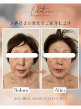 エクラヴィ(Eclatvie)/７０代★施術事例