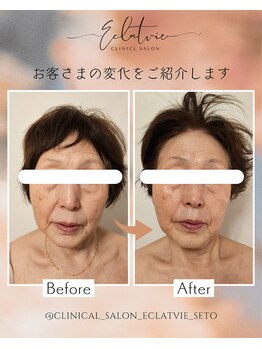エクラヴィ(Eclatvie)/70代★施術事例