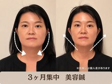ピュアハリ/3ヶ月集中でフェイスライン印象