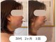ランティル(l’until)の写真/たるみほうれい線アゴ下もたつきに韓国美容レッドショットとハンドケアでスッキリとリフトアップしたお顔に