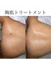 【背中ケア（背中上）】REVIハーブピーリング（90分）