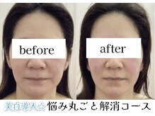 ヒトハナ(hitohana)/白☆透明美肌♪ビタミンC+Ａ導入