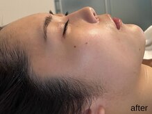 サロン ド エメ(salon de aimer)/【After】くすみ抜け・輪郭も♪